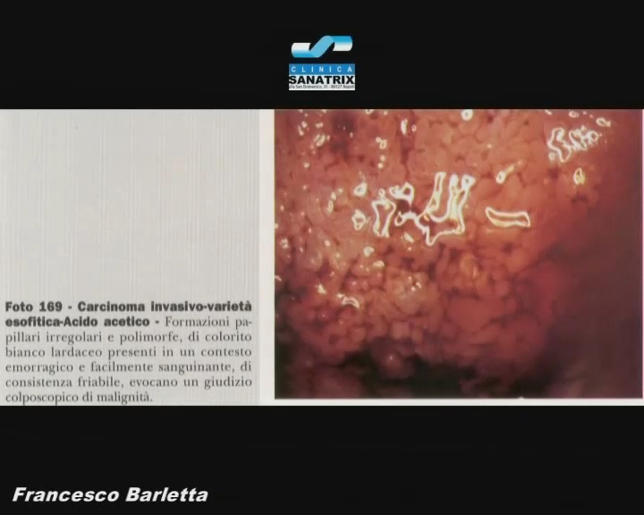 Colposcopie carcinomi invasivi