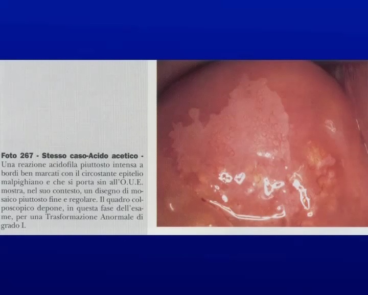 Condilomatosi virale