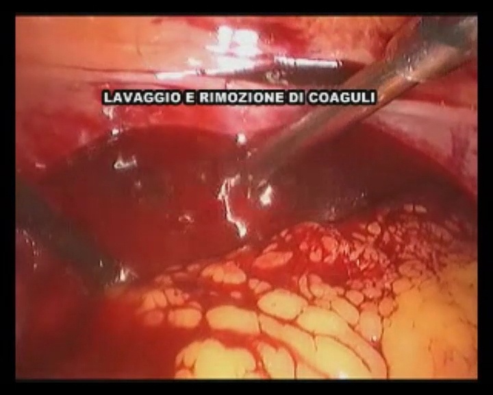 Emoperitoneo con salpingectomia