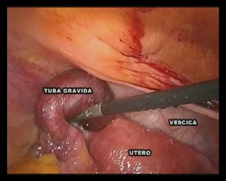 Emoperitoneo da extra