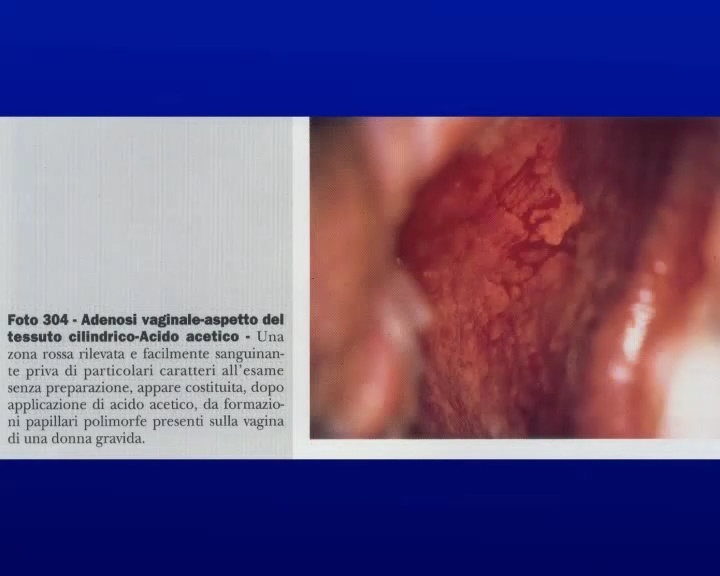 Gravidanze estroprogestinici e adenomi vaginali