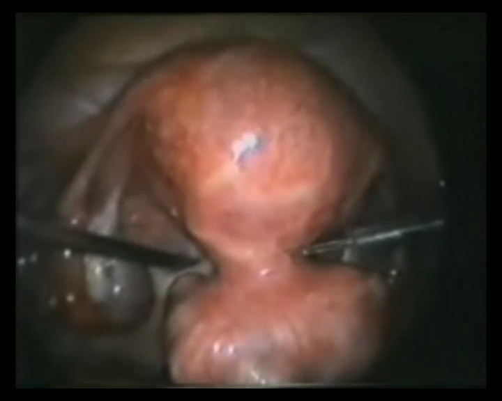 Miomectomia multipla