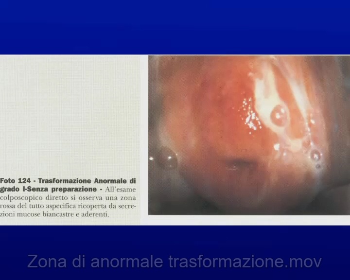 Zona di anormale trasformazione