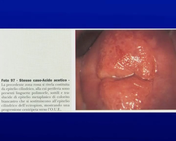 Zona di normale trasformazione